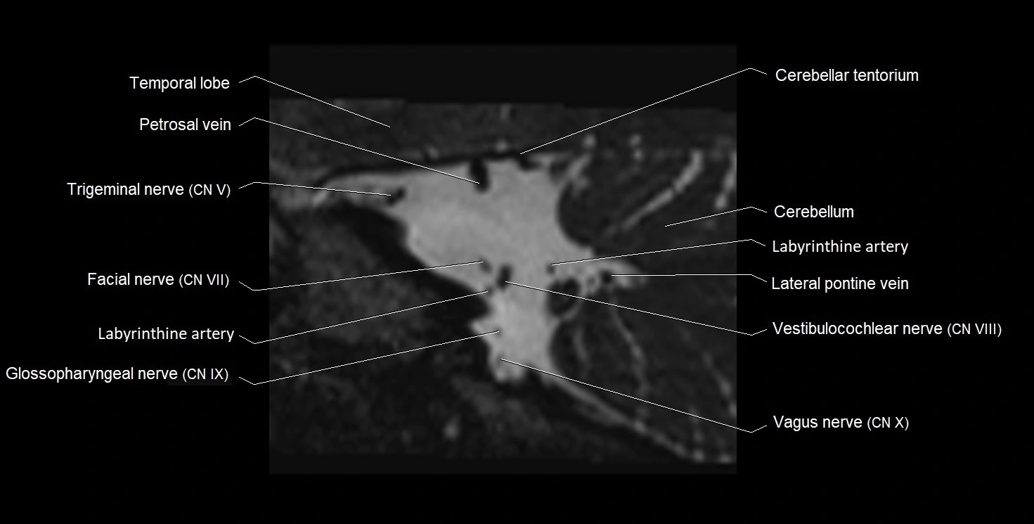 Internal auditory meatus (IAM) 3T sagittal cross sectional anatomy image 30.webp